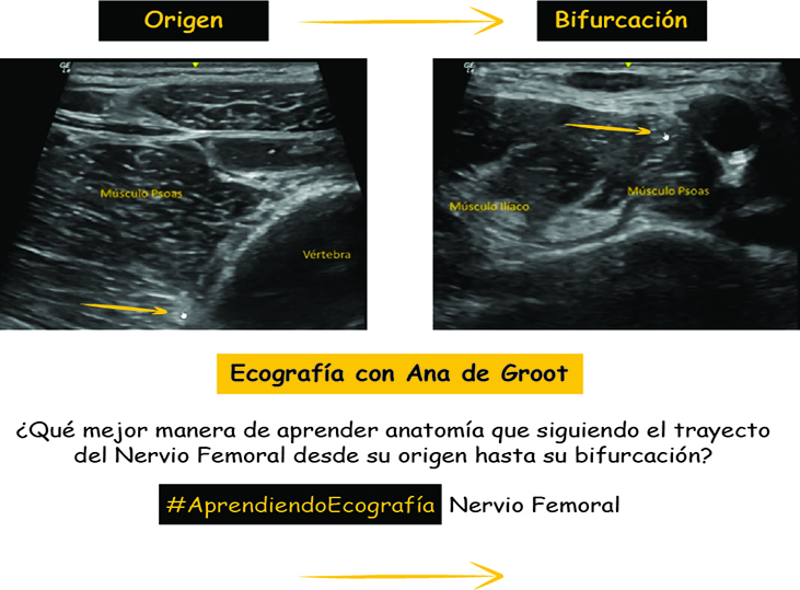 nervio-femoral-ecografia-con-ana-de-groot